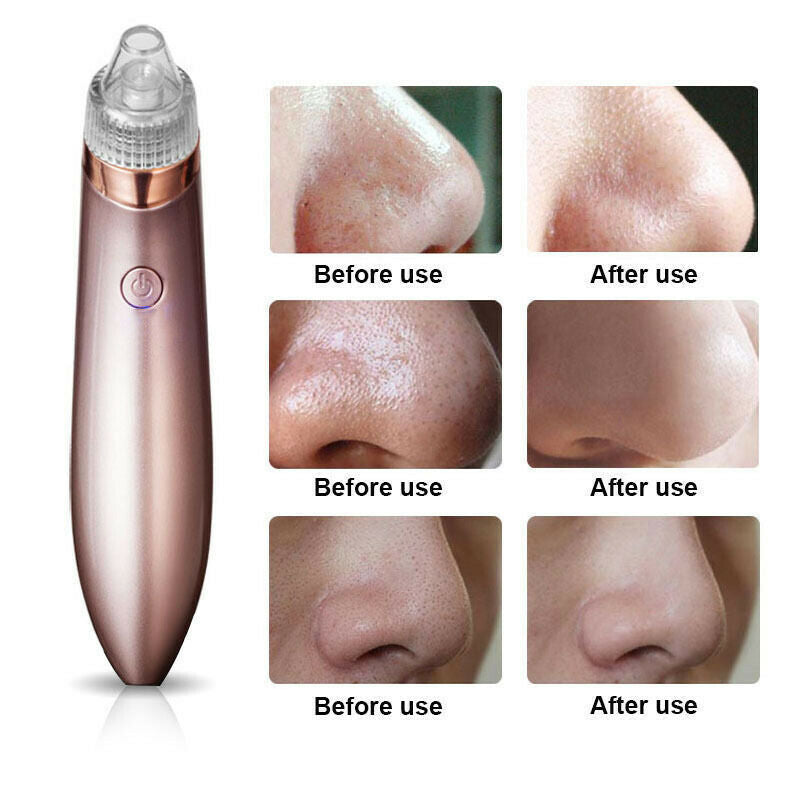 Electric Blackhead Vacuum Pore Cleaner Acne Pimple Remover Strong Suction Tools.